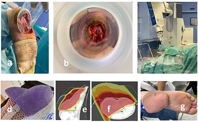 Practice-oriented solutions integrating intraoperative electron irradiation and personalized proton therapy for recurrent or unresectable cancers: Proof of concept and potential for dual FLASH effect